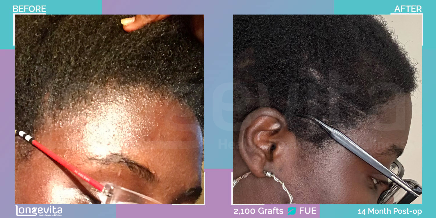 FUE hair transplant before and after, 2100 grafts, 2 zones covered