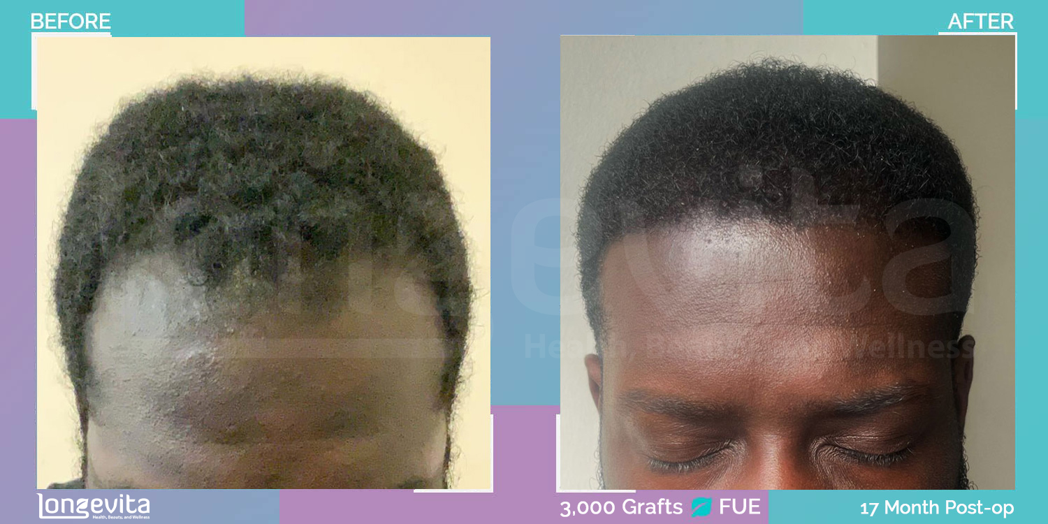 FUE hair transplant before and after, 3000 grafts, 2 zones covered, 20s male patient
