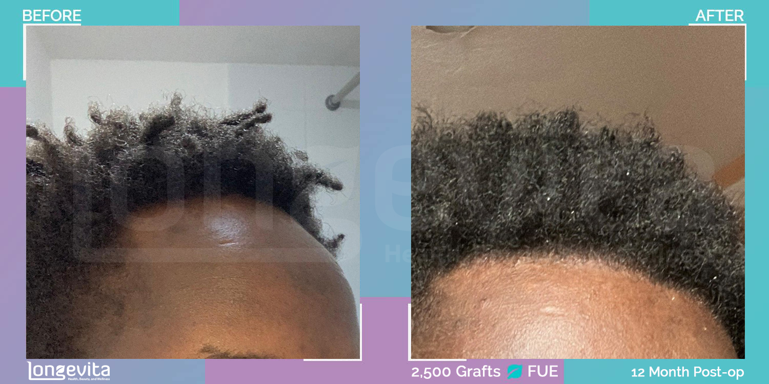FUE hair transplant before and after, 2500 grafts, 1 zone covered, 20s male patient