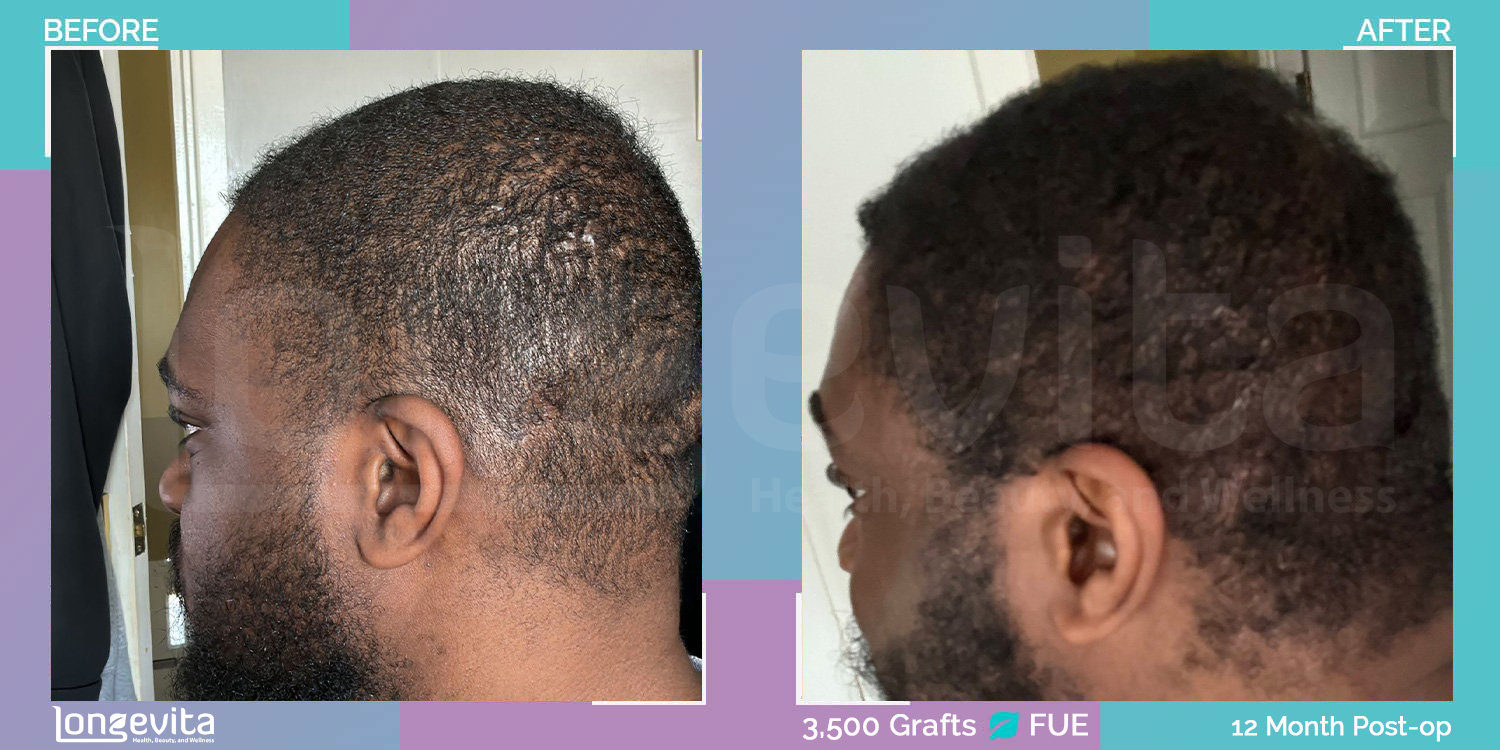 FUE hair transplant before and after, 3500 grafts, 3 zones covered, 20s male patient
