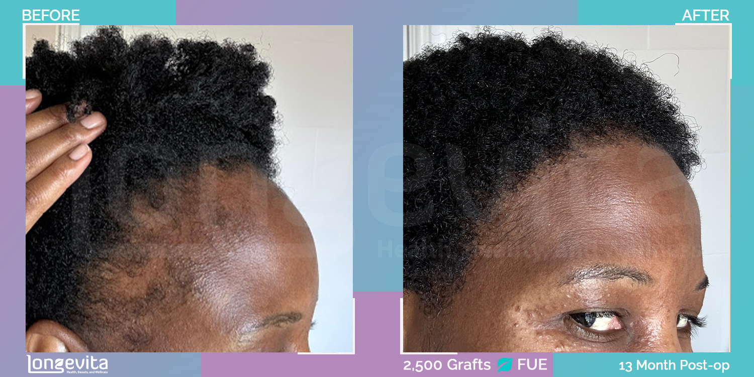 FUE hair transplant before and after, 2500 grafts, 2 zones covered, 30s female patient
