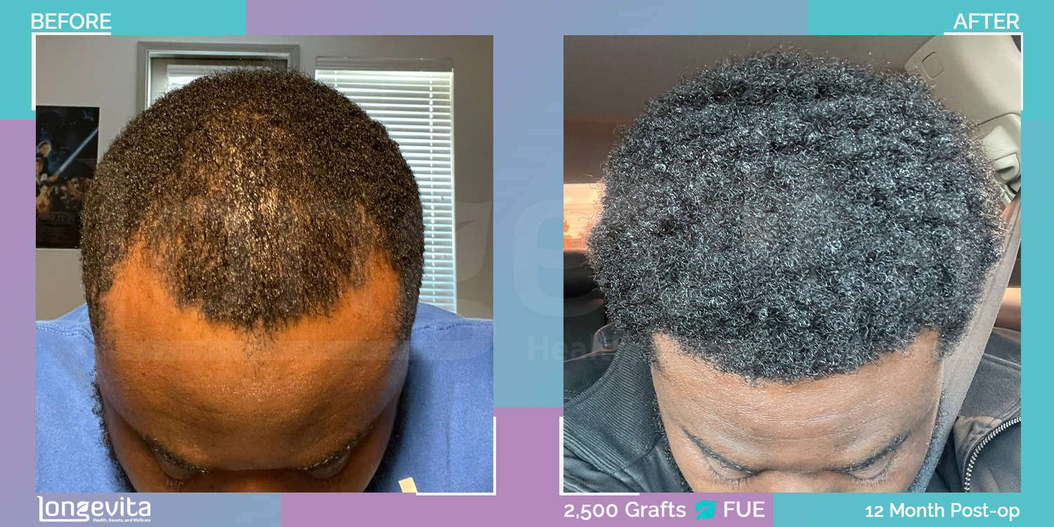 FUE hair transplant before and after, 2500 grafts, 1 zone covered, 30s male patient