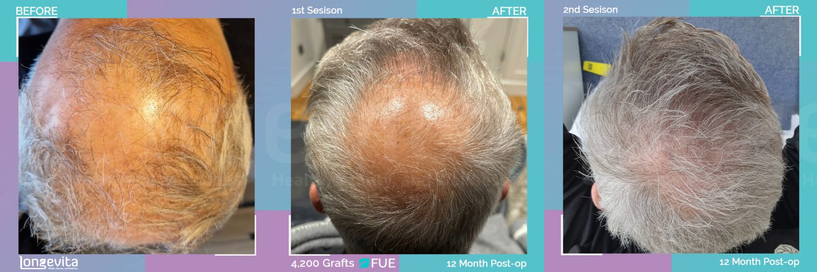 FUE hair transplant before and after, 4200 grafts, 3 zones covered, 40s male patient