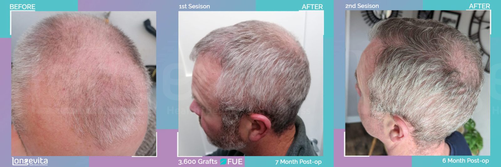 FUE hair transplant before and after, 3600 grafts, 4 zones covered, 50s male patient