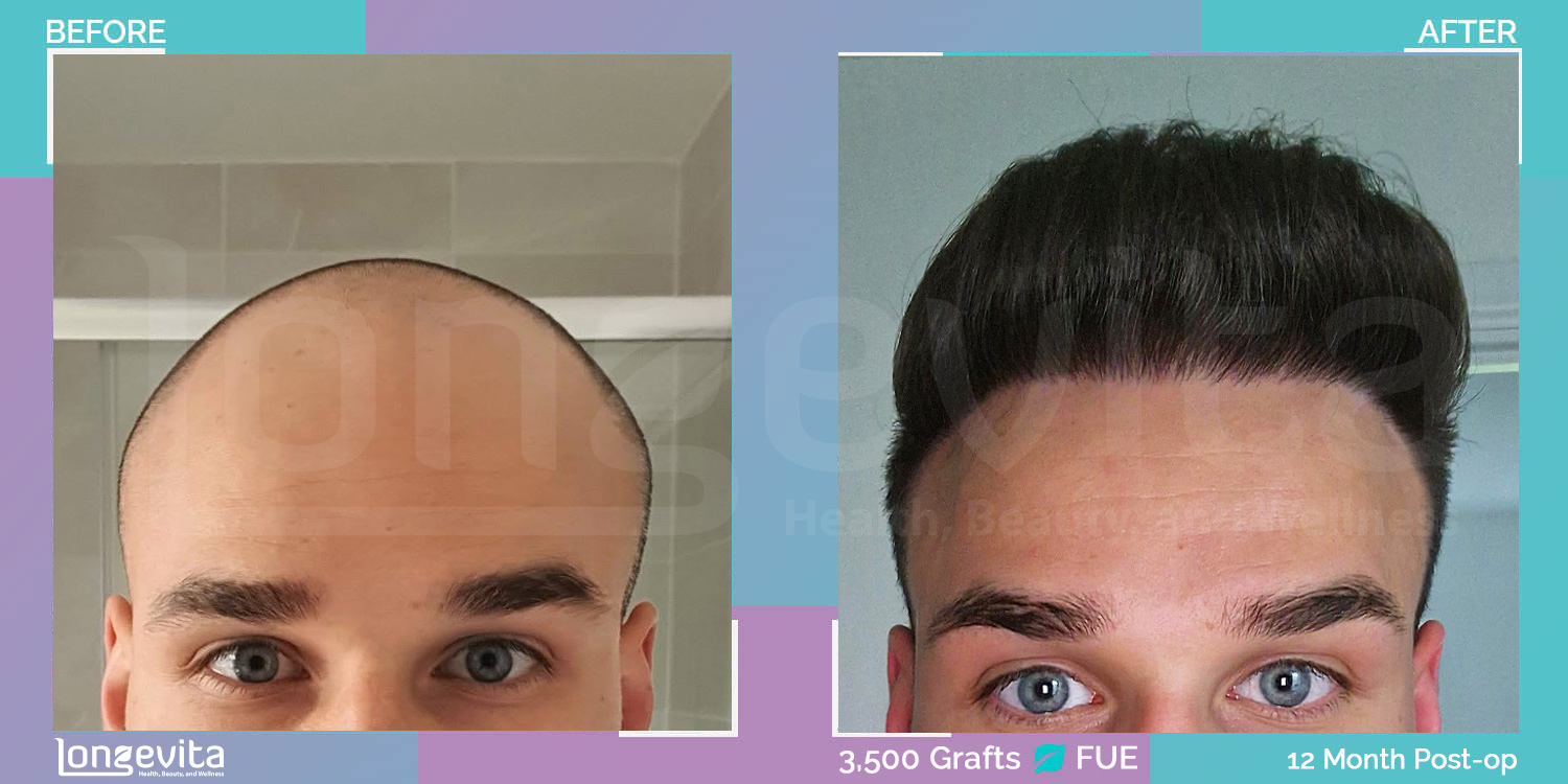 FUE hair transplant before and after, 3500 grafts, 4 zones covered, 20s male patient