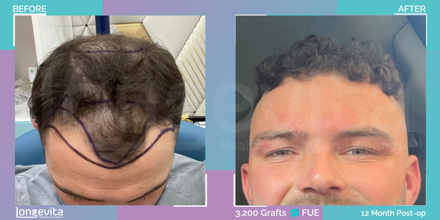 FUE hair transplant before and after, 3200 grafts, 5 zones covered, 20s male patient