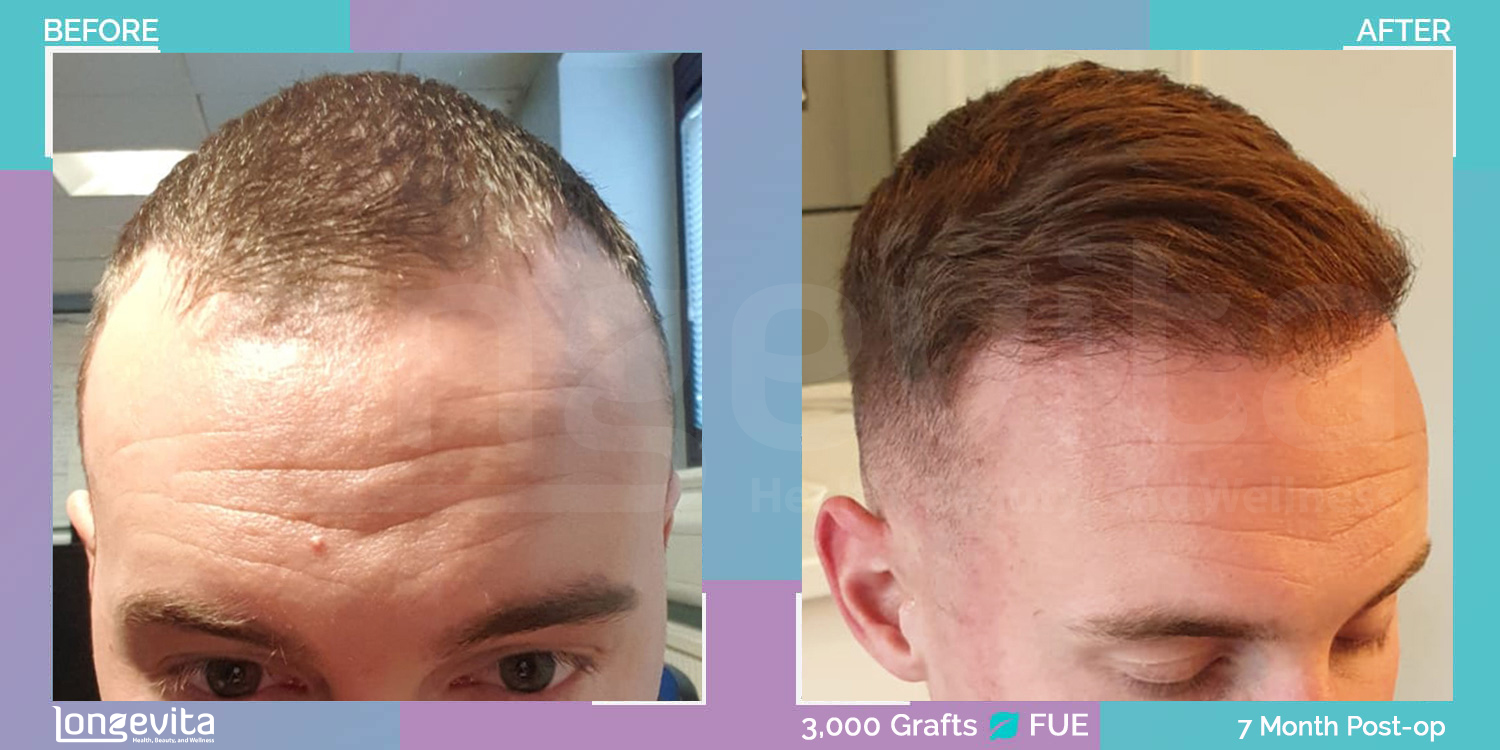 FUE hair transplant before and after, 3000 grafts, 1 zone covered, 20s male patient