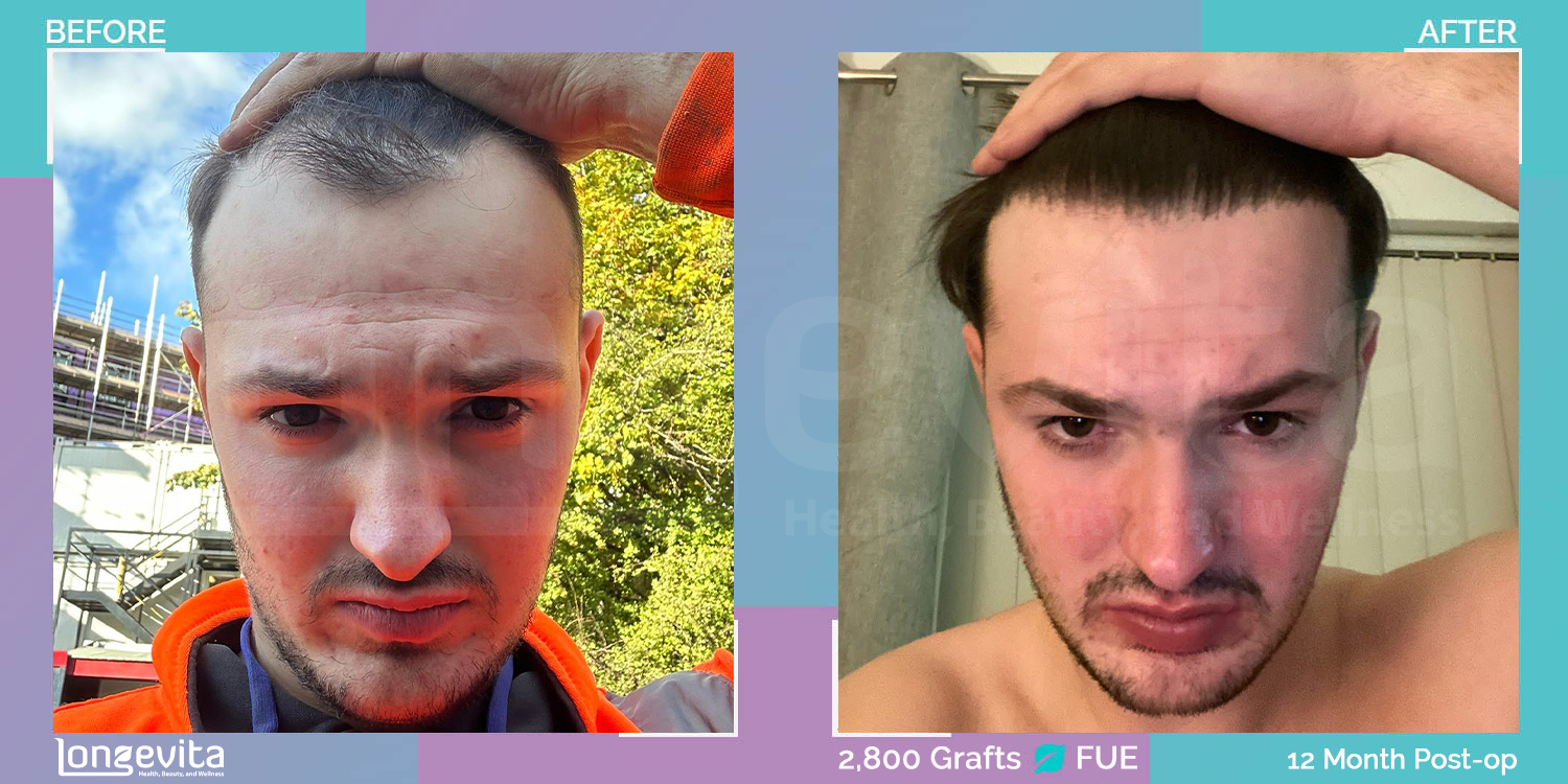 FUE hair transplant before and after, 2800 grafts, 1 zone covered, 20s male patient