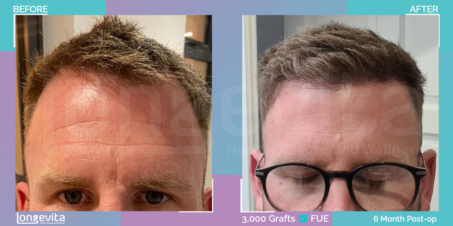 FUE hair transplant before and after, 3000 grafts, 1 zone covered, 40s male patient
