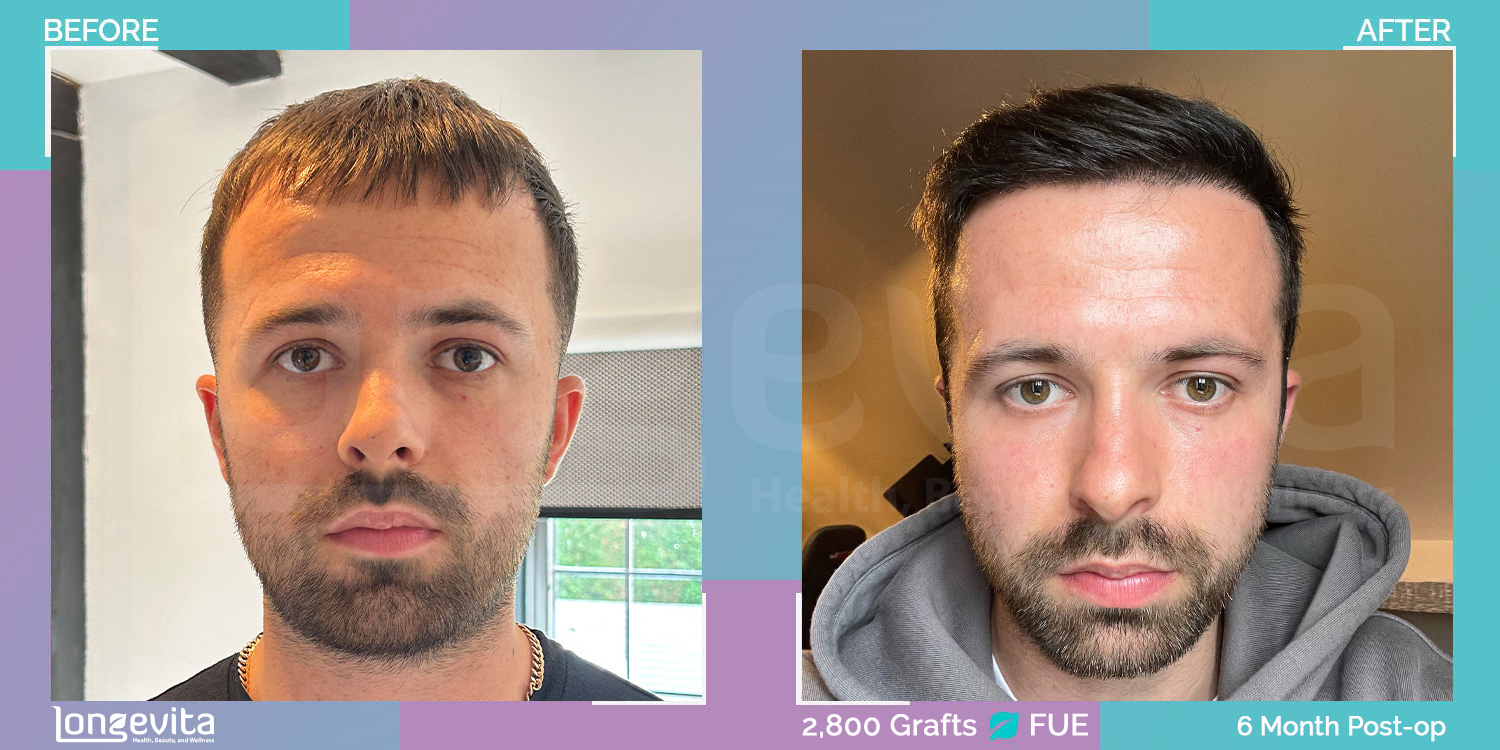 FUE hair transplant before and after, 2800 grafts, 1 zone covered, 20s male patient