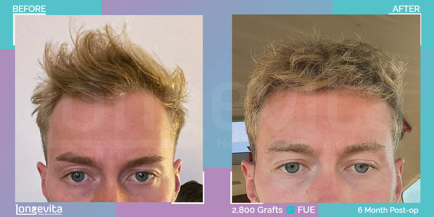 FUE hair transplant before and after, 2800 grafts, 2 zones covered, 20s male patient