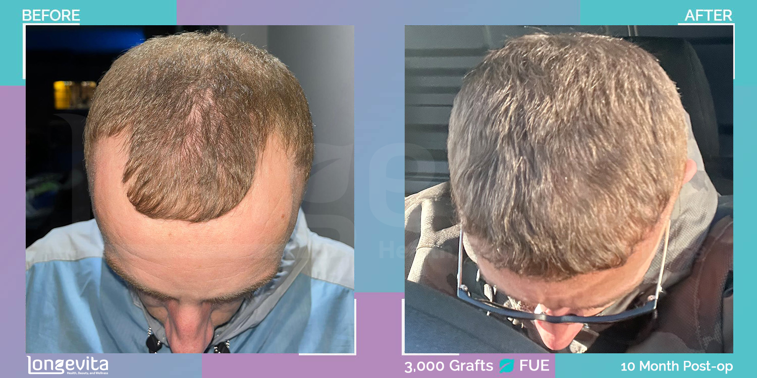 FUE hair transplant before and after, 3000 grafts, 1 zone covered, 20s male patient