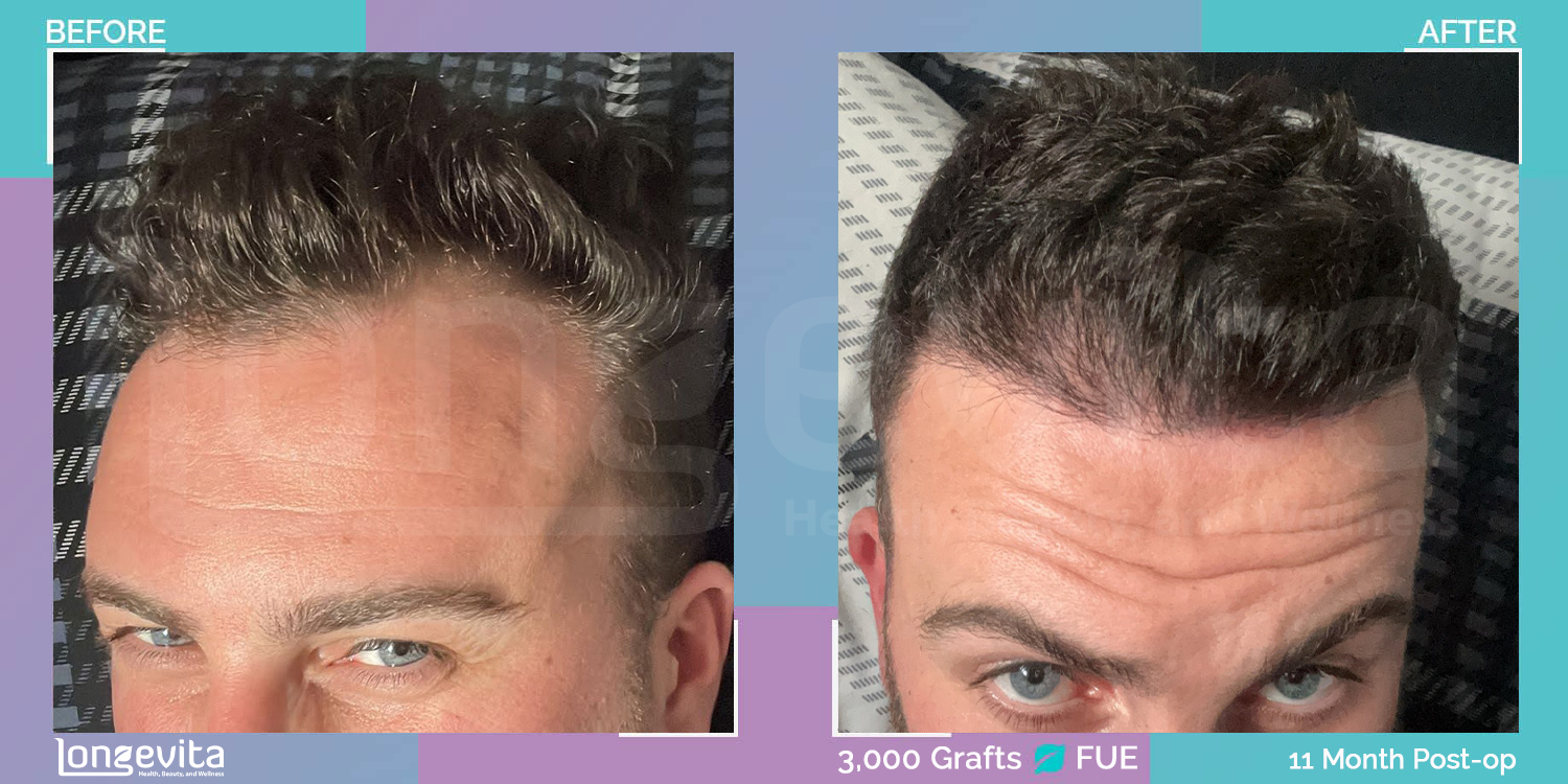 FUE hair transplant before and after, 3000 grafts, 1 zone covered, 30s male patient