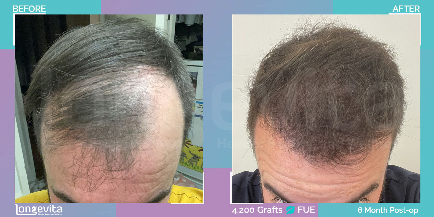 FUE hair transplant before and after, 4200 grafts, 4 zones covered, 30s male patient