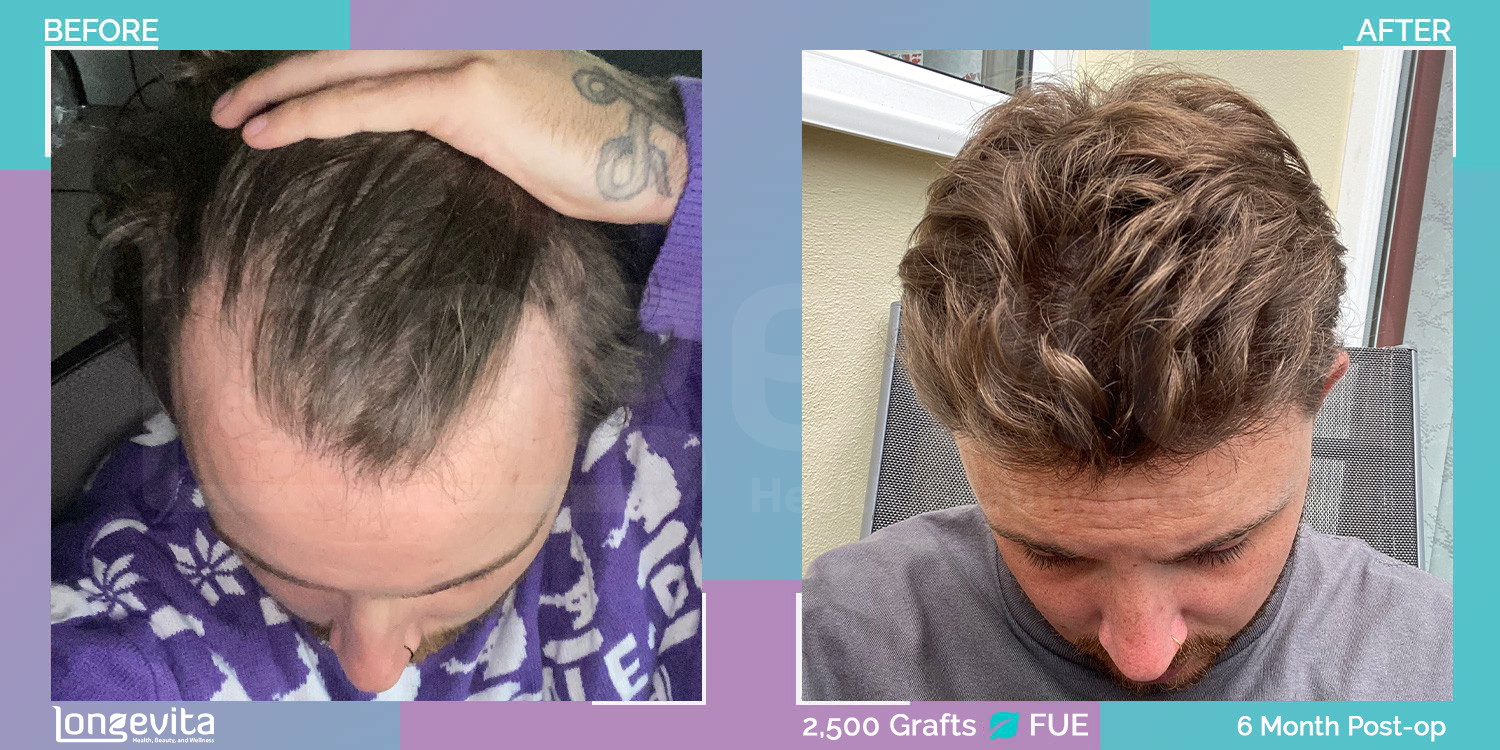 FUE hair transplant before and after, 2500 grafts, 1 zone covered, 30s male patient