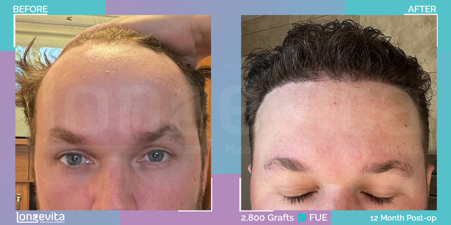FUE hair transplant before and after, 2800 grafts, 1 zone covered, 20s male patient