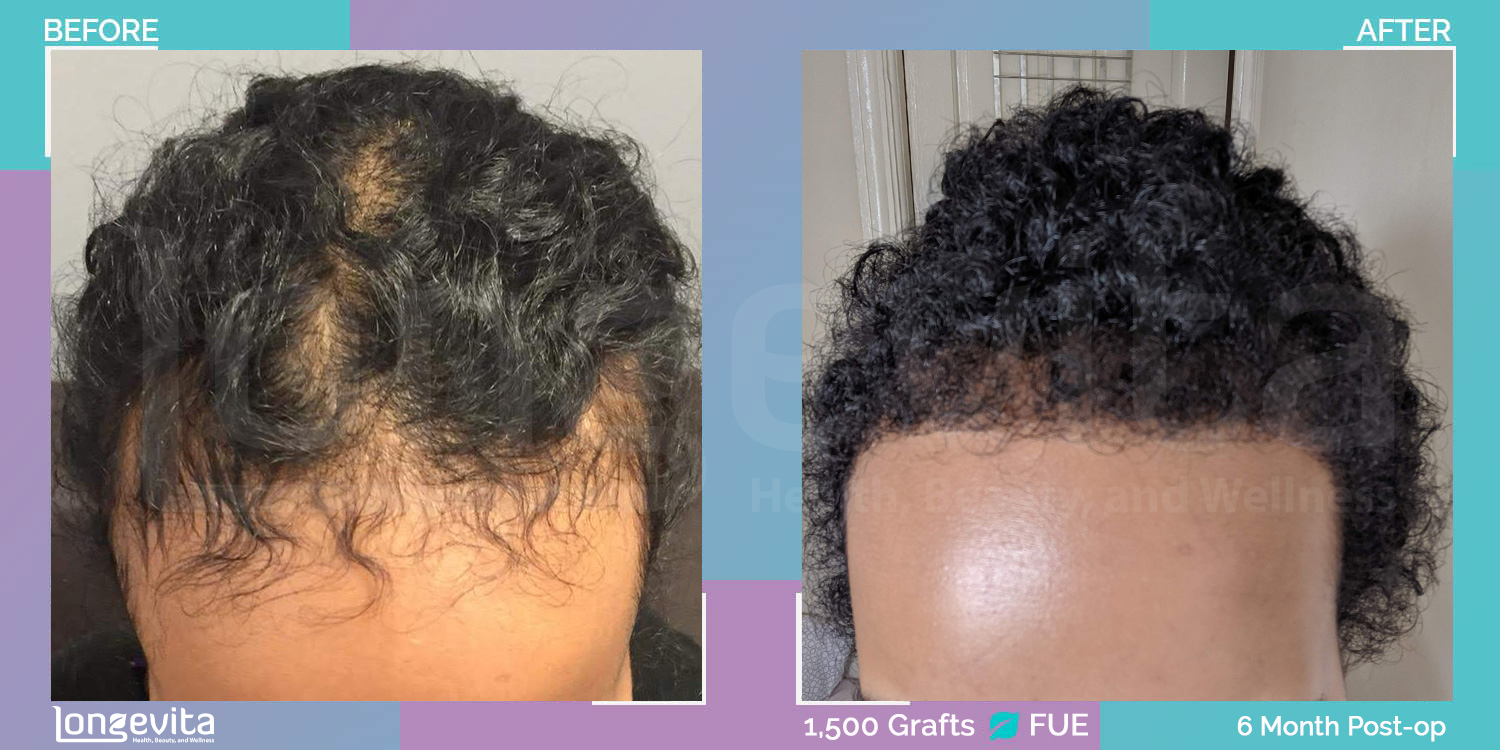 FUE hair transplant before and after, 1500 grafts, 3 zones covered, 20s female patient