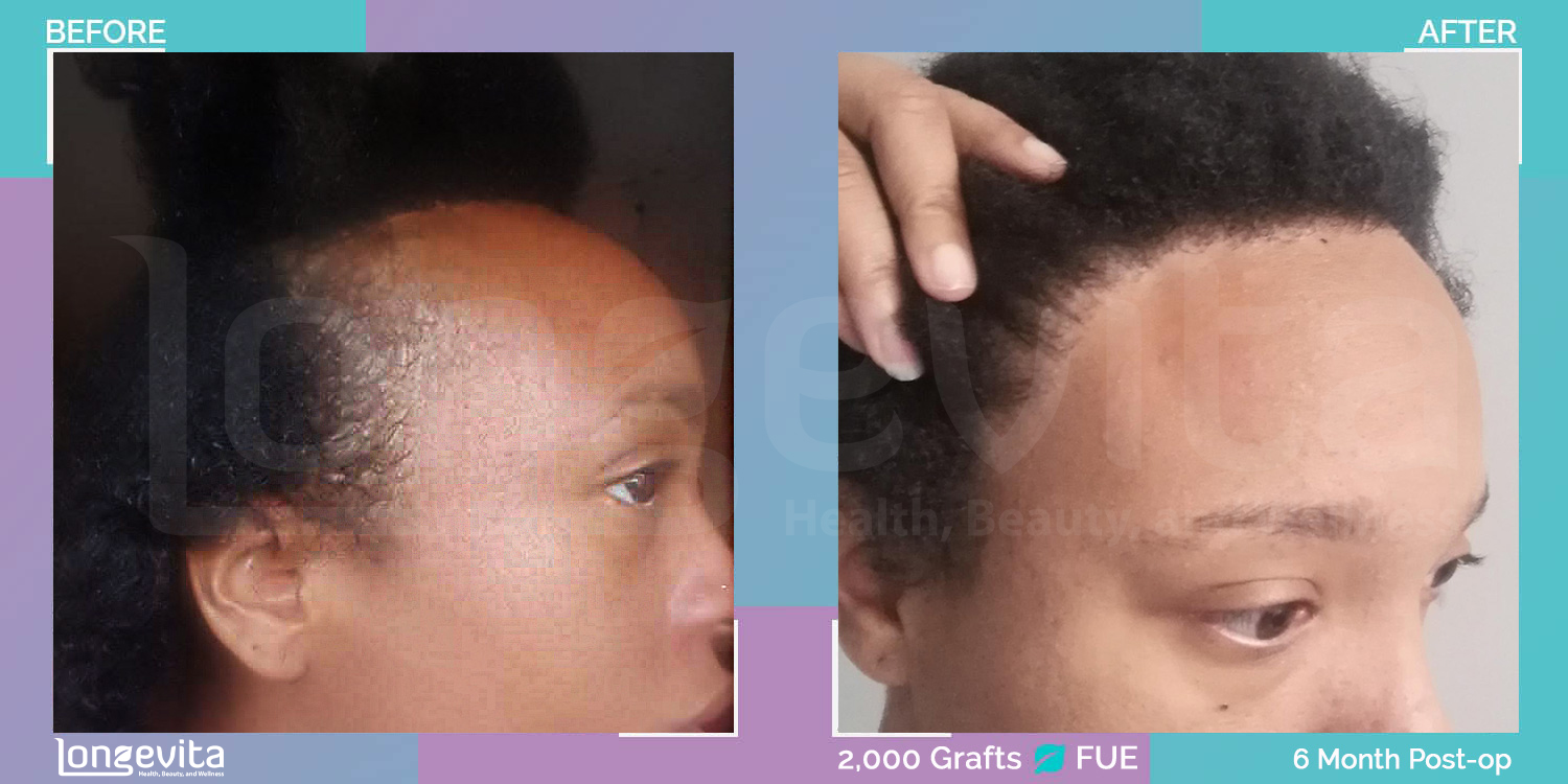 FUE hair transplant before and after, 2000 grafts, 3 zones covered, 30s female patient