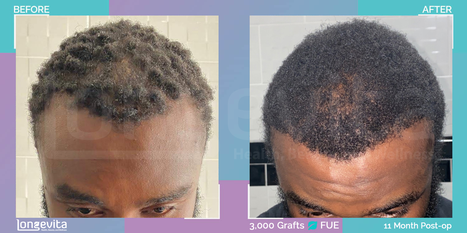 FUE hair transplant before and after, 3000 grafts, 6 zones covered, 30s male patient