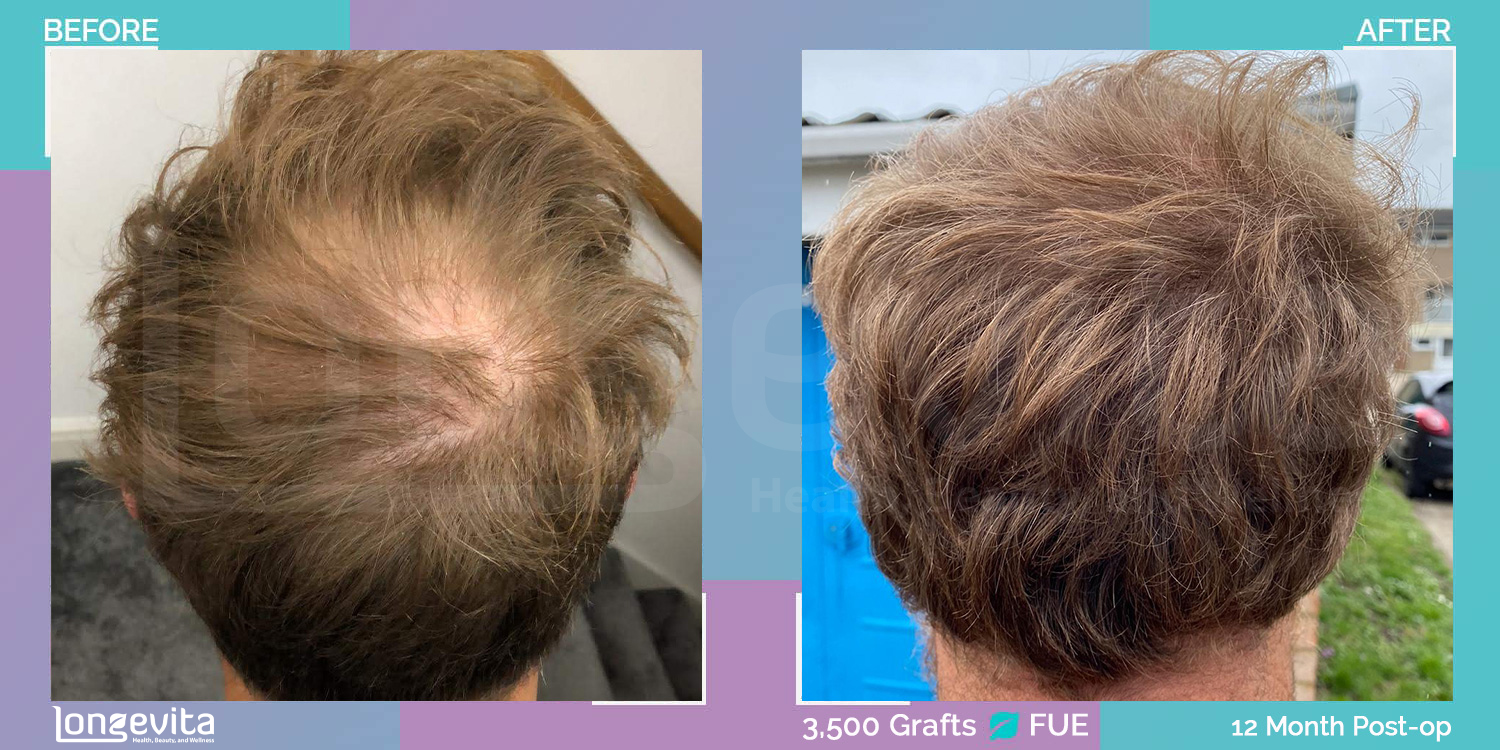 FUE hair transplant before and after, 3500 grafts, 2 zones covered, 30s male patient