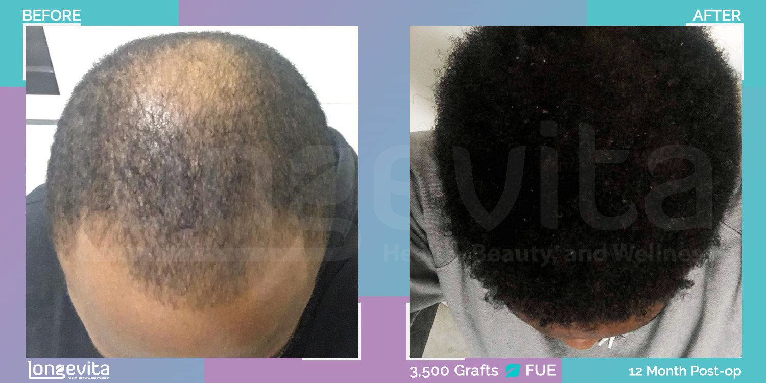 FUE hair transplant before and after, 3500 grafts, 4 zones covered, 20s male patient