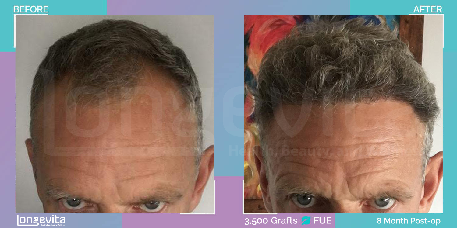 FUE hair transplant before and after, 3500 grafts, 4 zones covered, 40s male patient