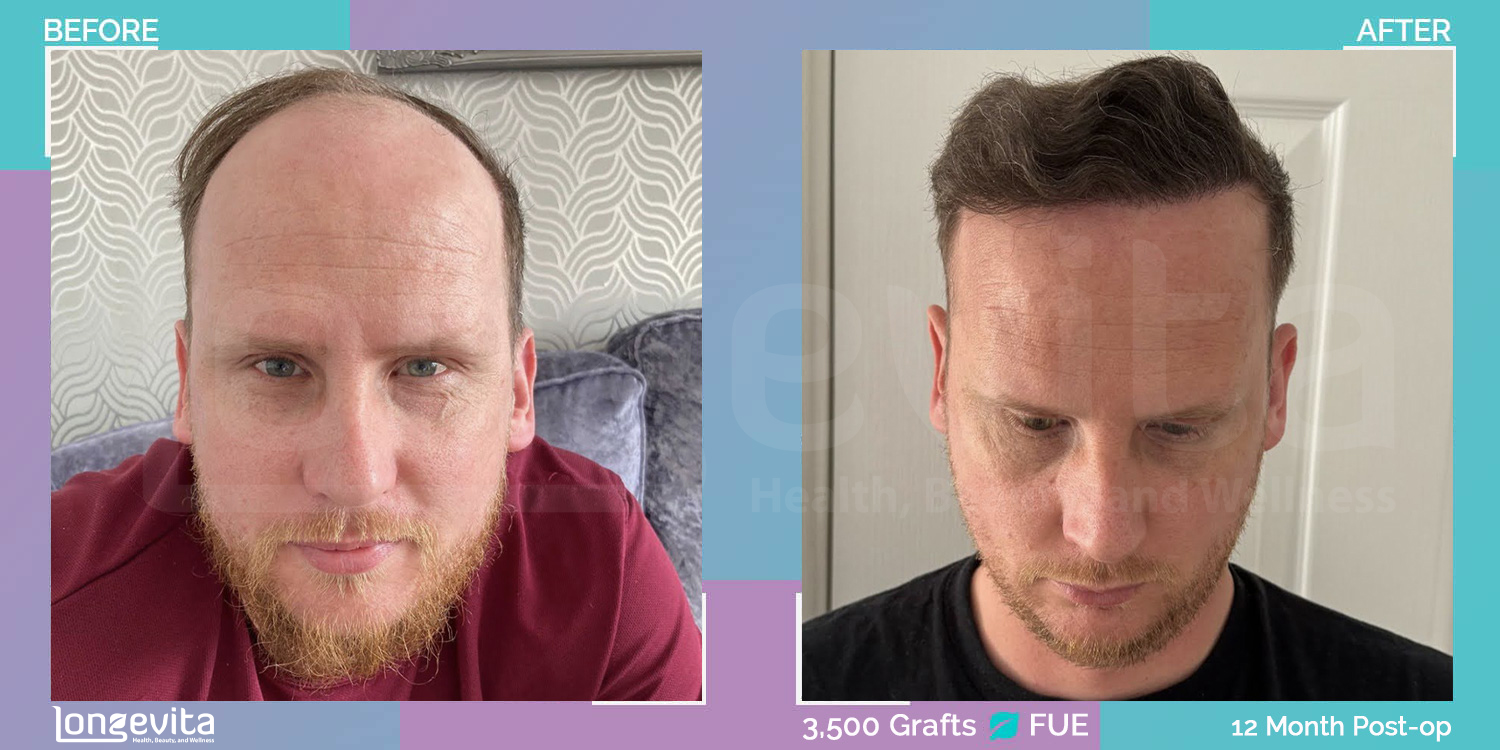 FUE hair transplant before and after, 3500 grafts, 3 zones covered, 30s male patient