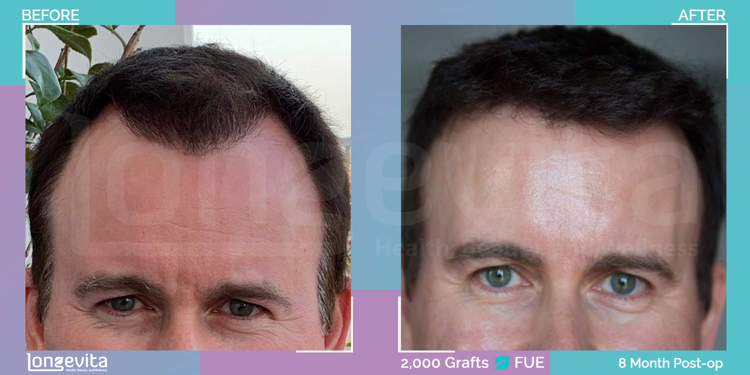 FUE hair transplant before and after, 2000 grafts, 4 zones covered, 50s male patient