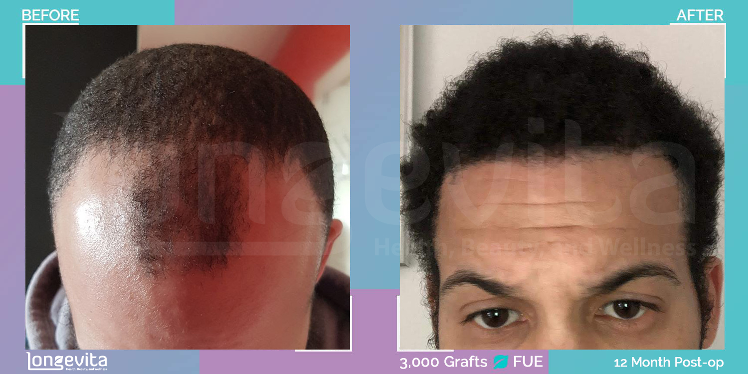 FUE hair transplant before and after, 3000 grafts, 3 zones covered, 30s male patient