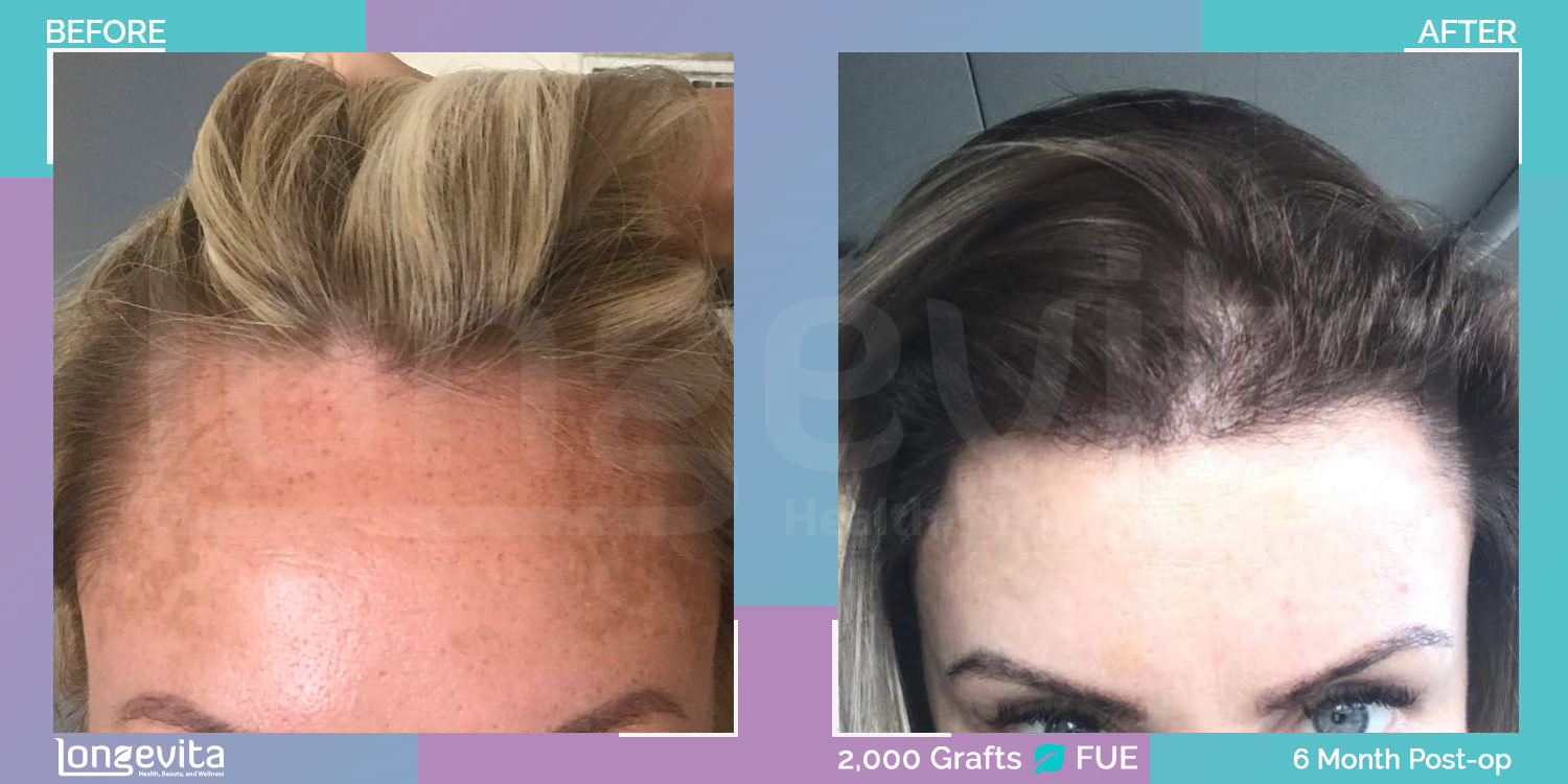 FUE hair transplant before and after, 2000 grafts, 2 zones covered