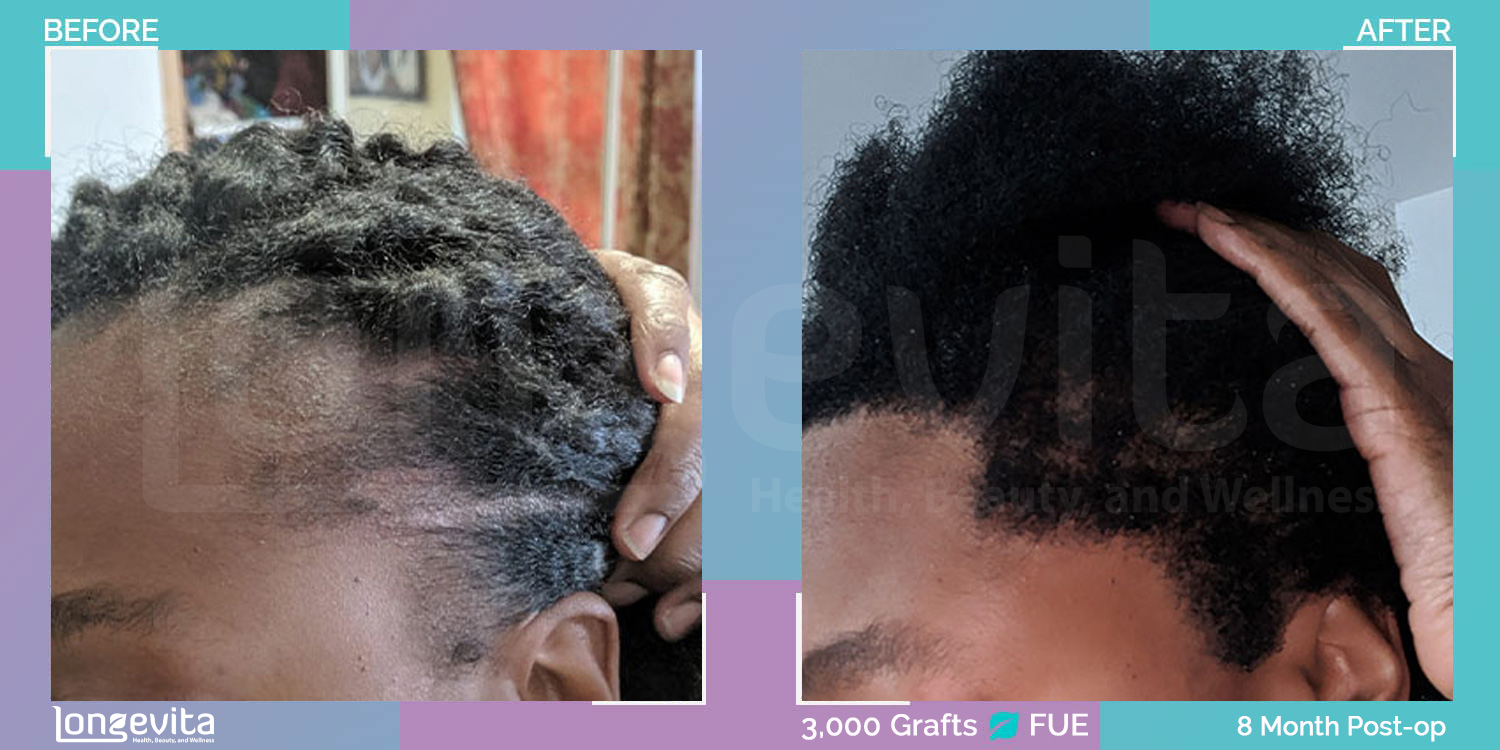 FUE hair transplant before and after, 3000 grafts, 4 zones covered, 30s female patient