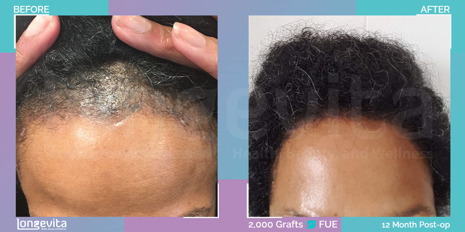 FUE hair transplant before and after, 2000 grafts, 2 zones covered