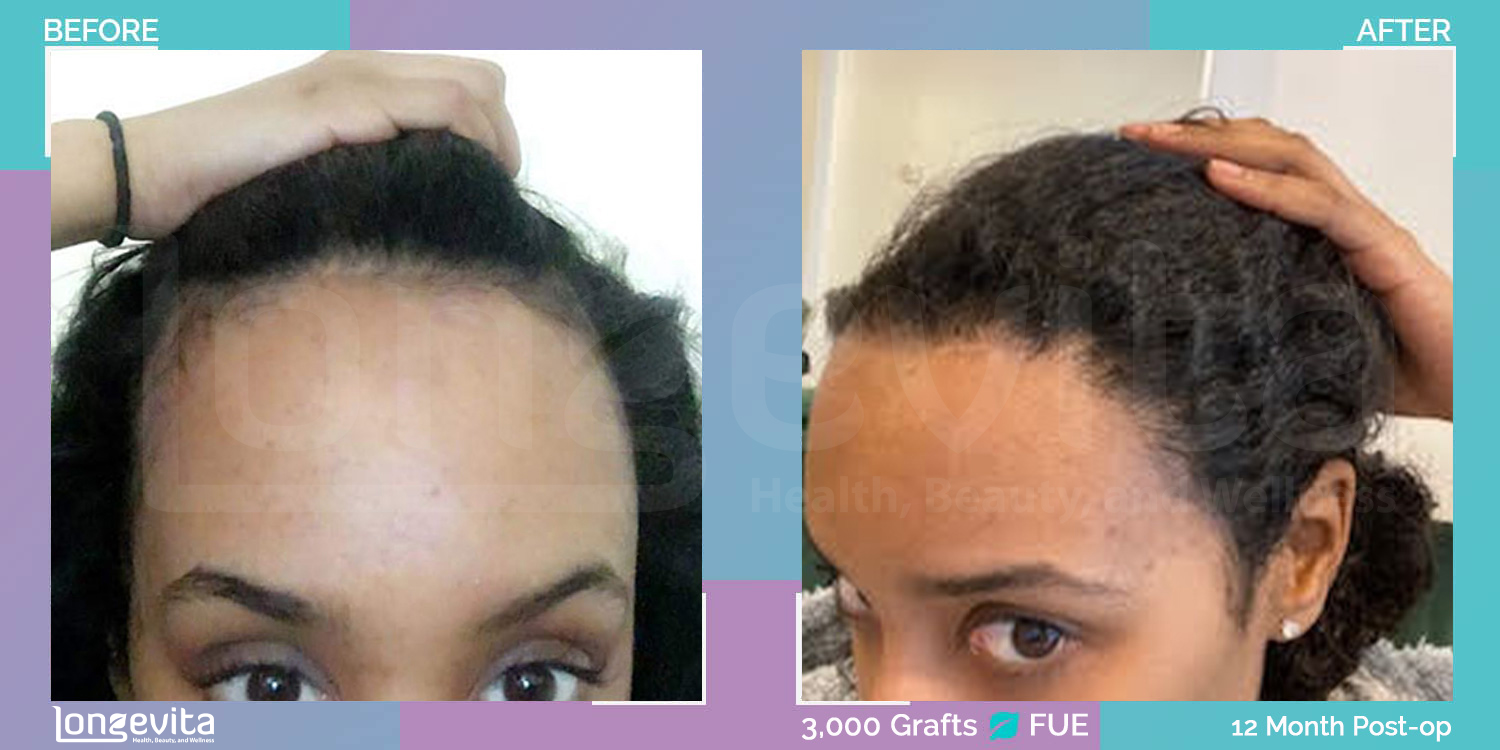 FUE hair transplant before and after, 3000 grafts, 2 zones covered, 30s female patient