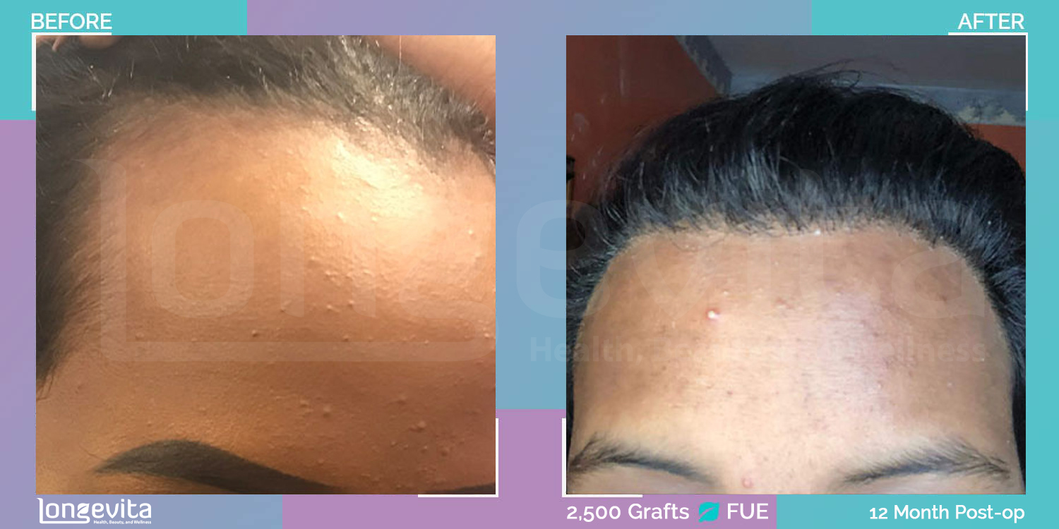 FUE hair transplant before and after, 2500 grafts, 2 zones covered