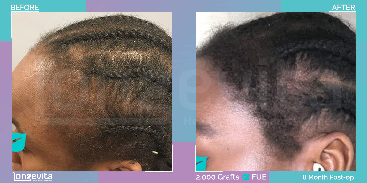 FUE hair transplant before and after, 2000 grafts, 2 zones covered