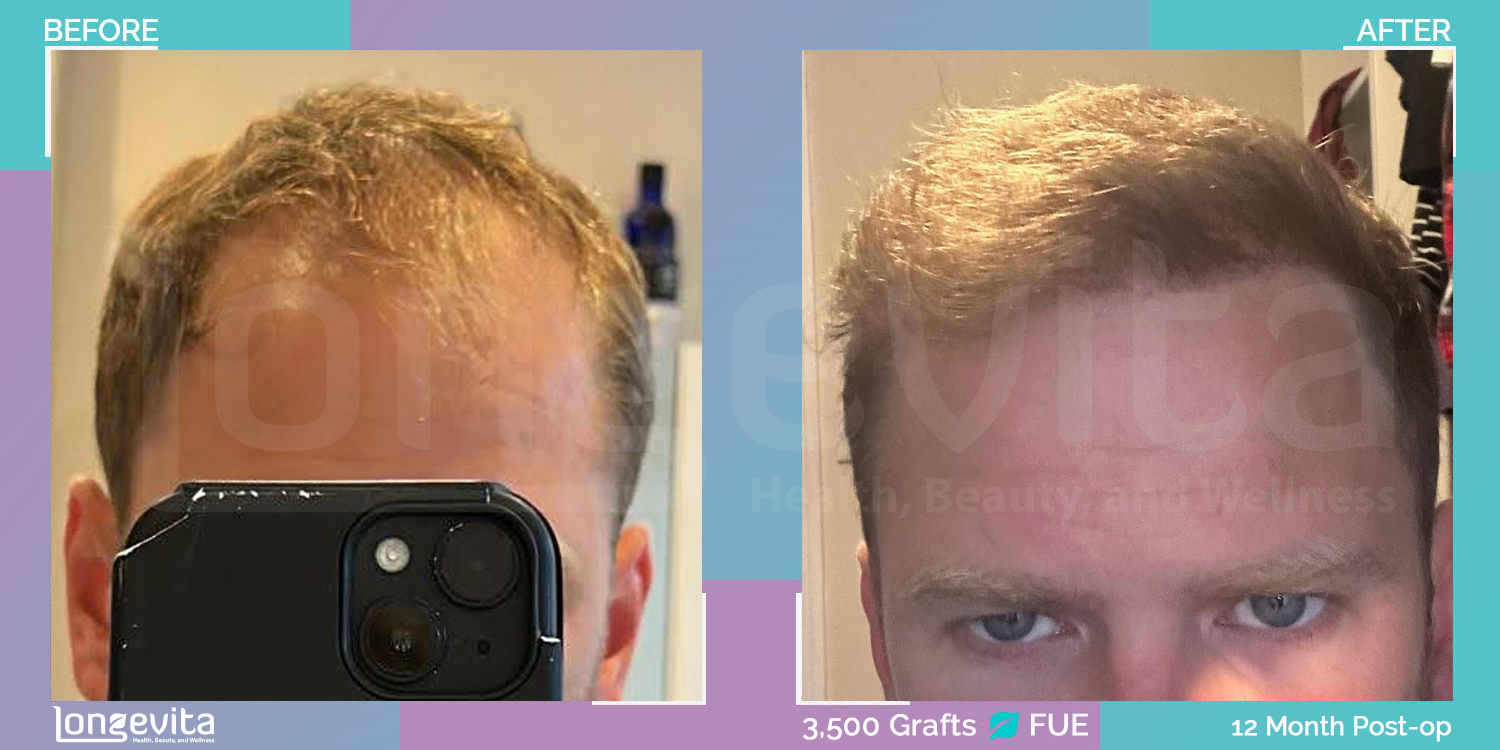 FUE hair transplant before and after, 3500 grafts, 2 zones covered, 30s male patient