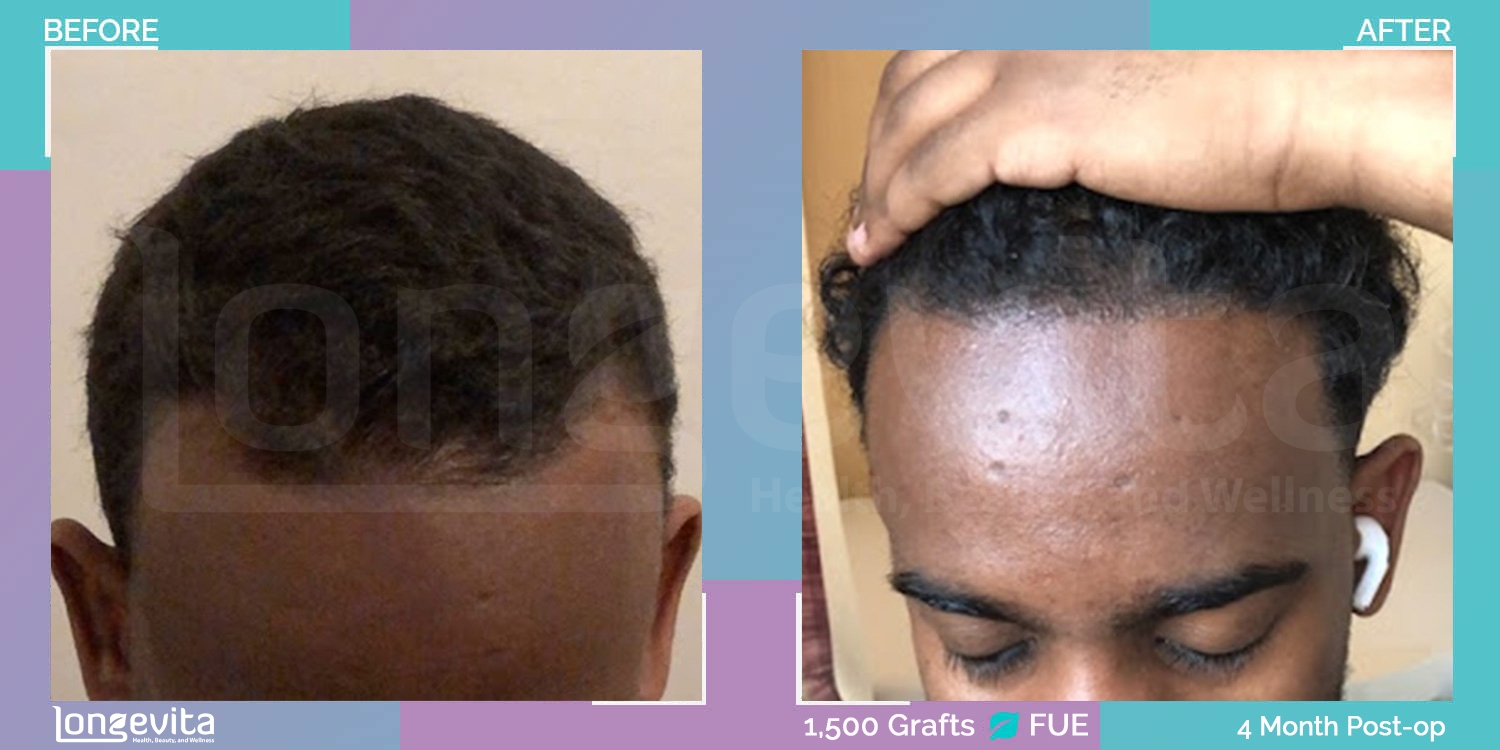 FUE hair transplant before and after, 1500 grafts, 1 zone covered, 20s male patient