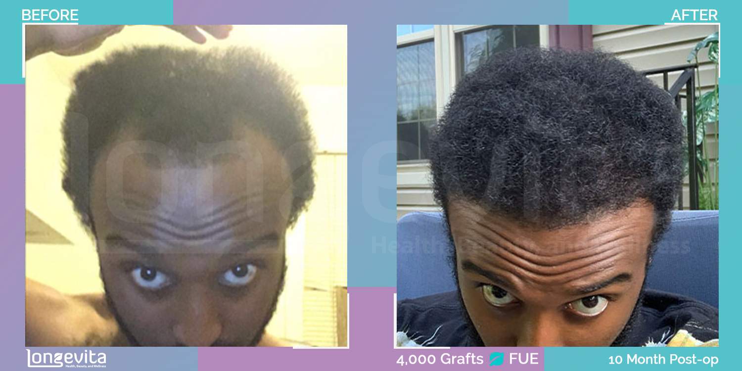 FUE hair transplant before and after, 4000 grafts, 6 zones covered, 20s male patient