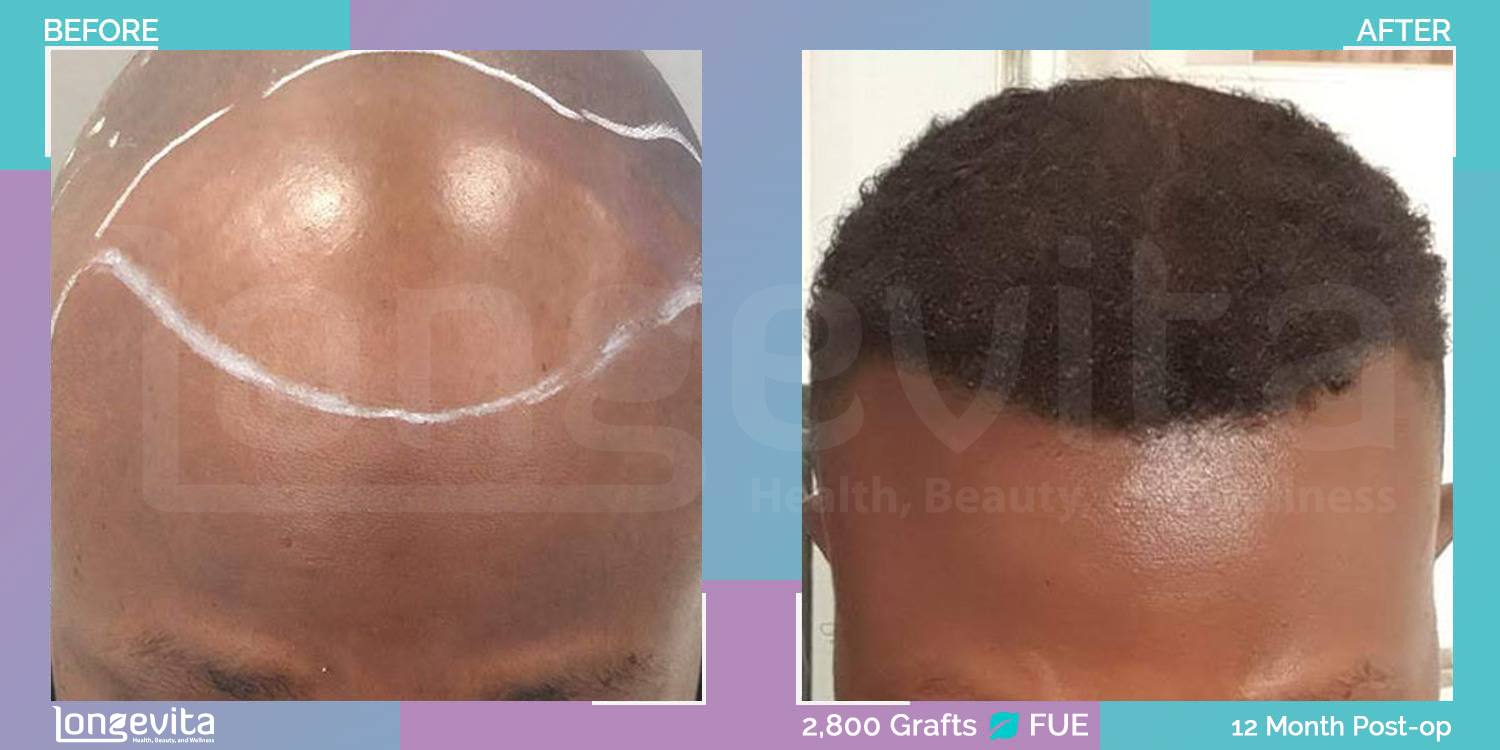 FUE hair transplant before and after, 2800 grafts, 4 zones covered