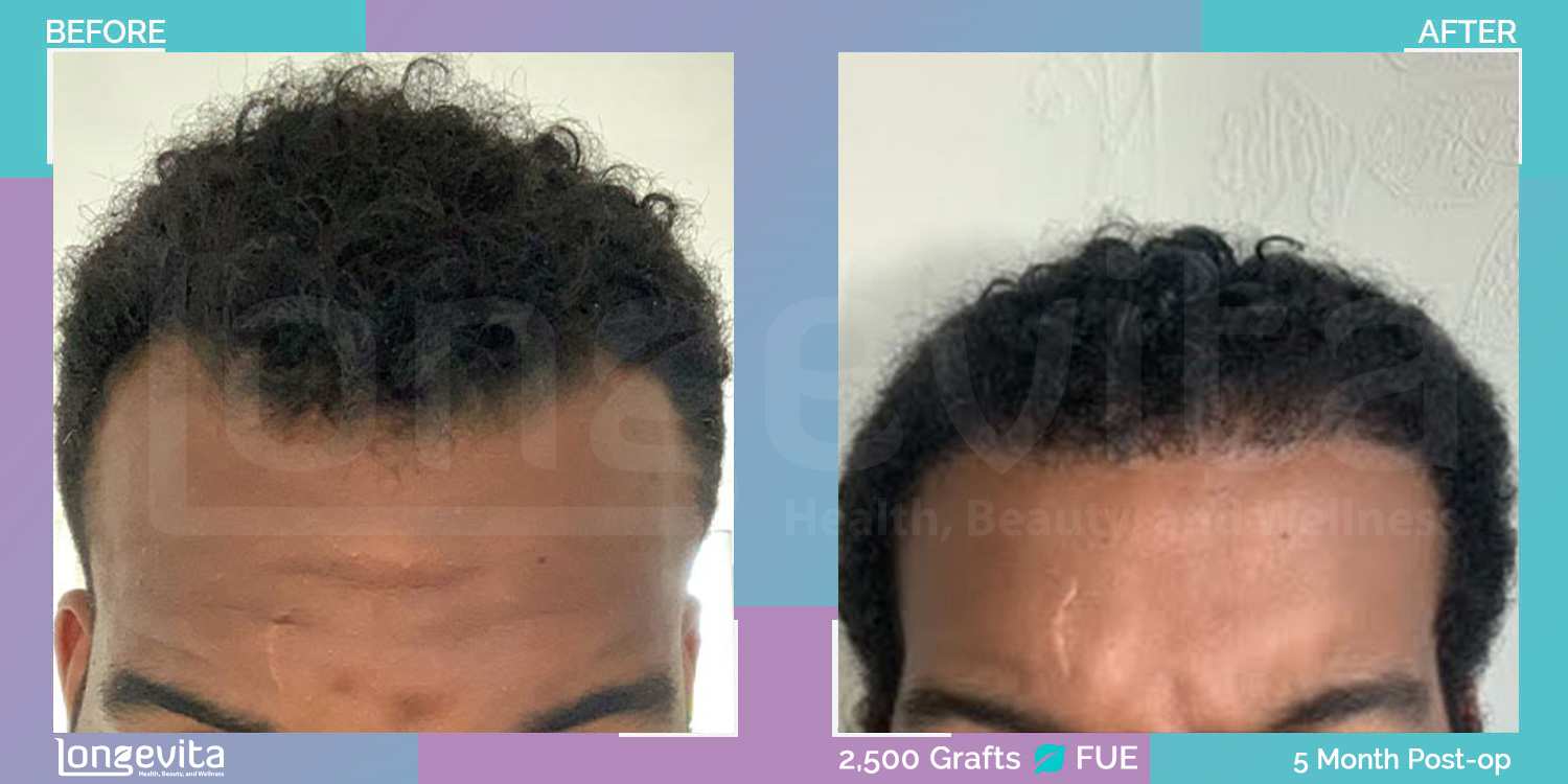 FUE hair transplant before and after, 2500 grafts, 2 zones covered, 30s male patient