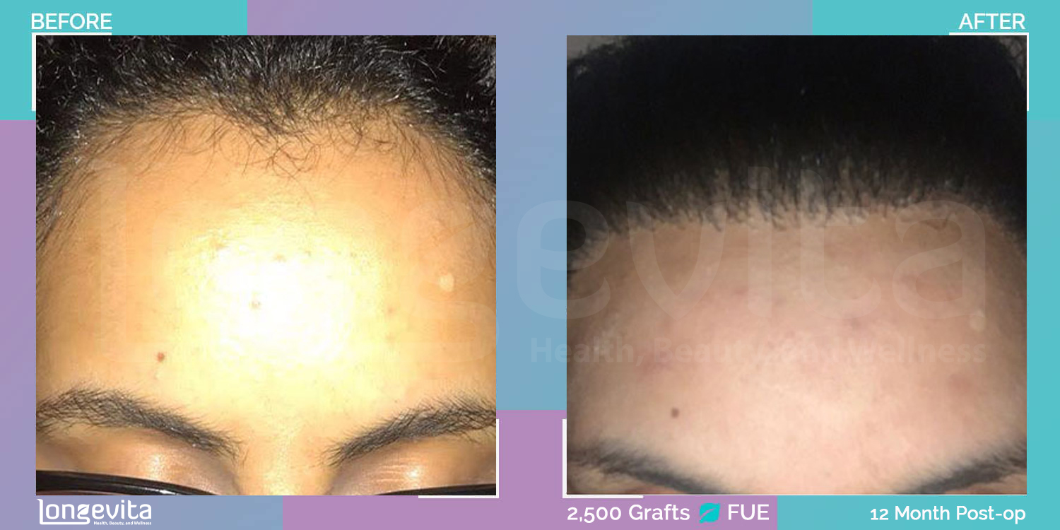 FUE hair transplant before and after, 2500 grafts, 2 zones covered, 20s female patient