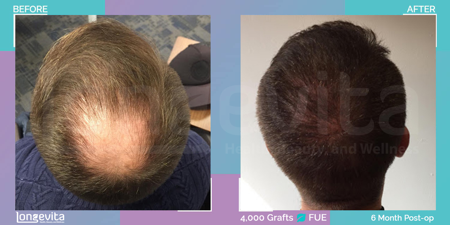 FUE hair transplant before and after, 4000 grafts, 4 zones covered, 30s male patient