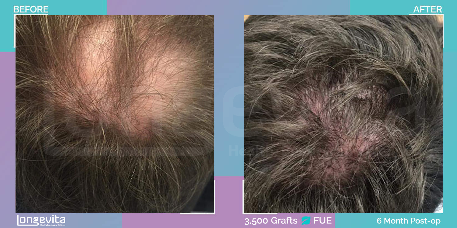 FUE hair transplant before and after, 3500 grafts, 6 zones covered, 20s male patient