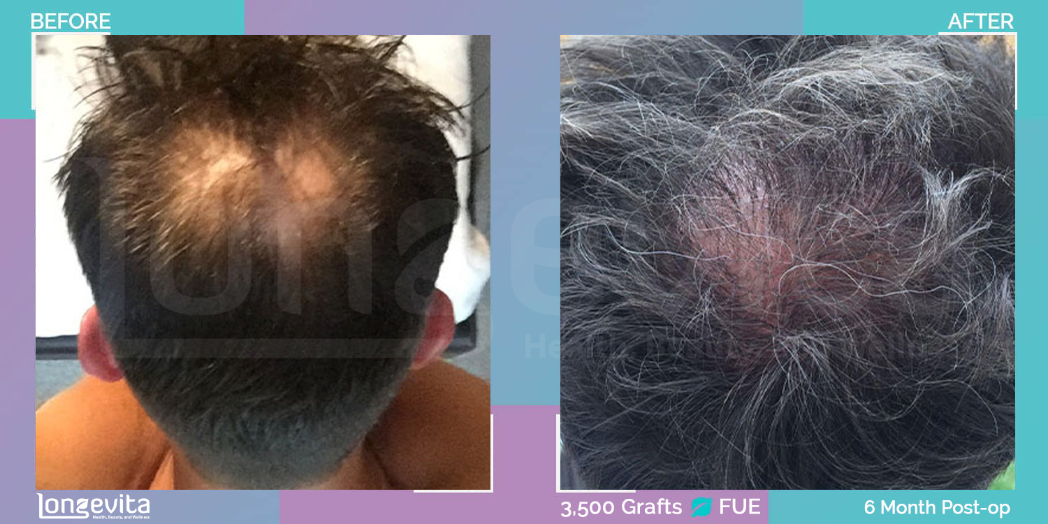 FUE hair transplant before and after, 3500 grafts, 6 zones covered, 40s male patient