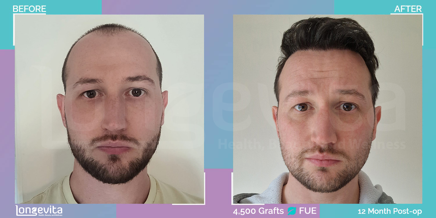 FUE hair transplant before and after, 4500 grafts, 3 zones covered, 30s male patient