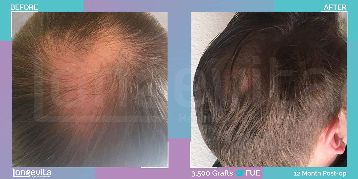 FUE hair transplant before and after, 3500 grafts, 5 zones covered