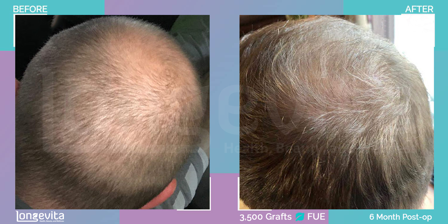 FUE hair transplant before and after, 3500 grafts, 4 zones covered