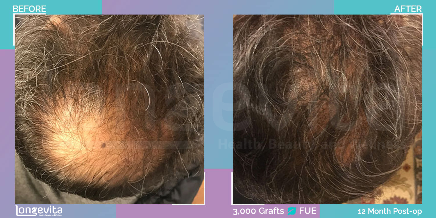 FUE hair transplant before and after, 3000 grafts, 4 zones covered, 40s male patient