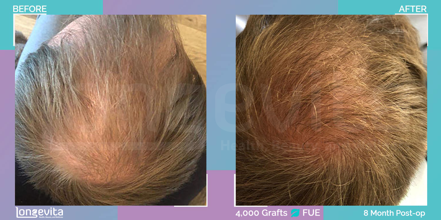 FUE hair transplant before and after, 4000 grafts, 6 zones covered, 20s male patient