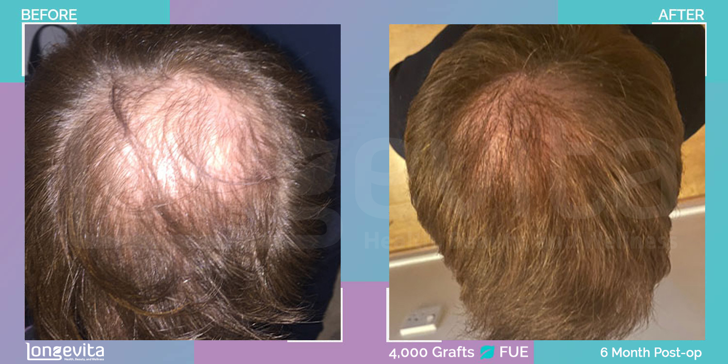 FUE hair transplant before and after, 4000 grafts, 4 zones covered, 20s male patient